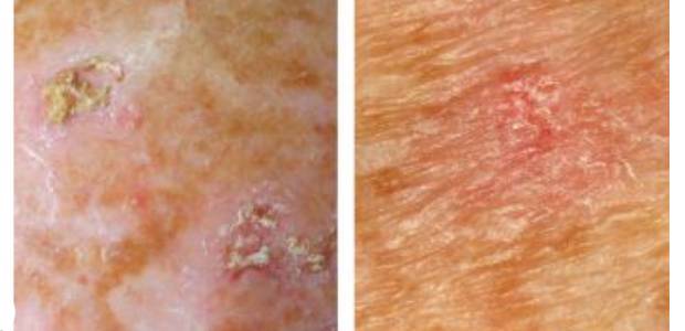 Immagine relativa al contenuto Cheratosi attinica. Torna la campagna Derma Point