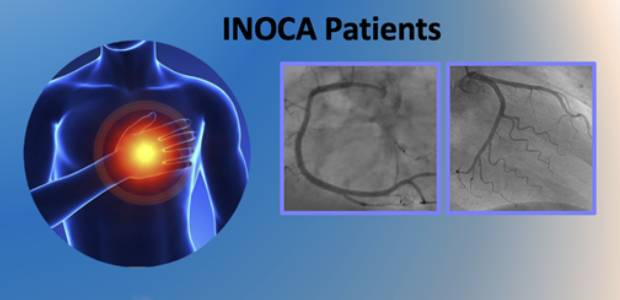 Immagine relativa al contenuto Glicemia alta e ischemia cardiaca, anche in pazienti non diabetici
