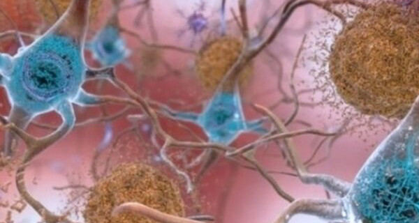 Immagine relativa al contenuto Malattia di Alzheimer e microbiota intestinale: confermato il collegamento