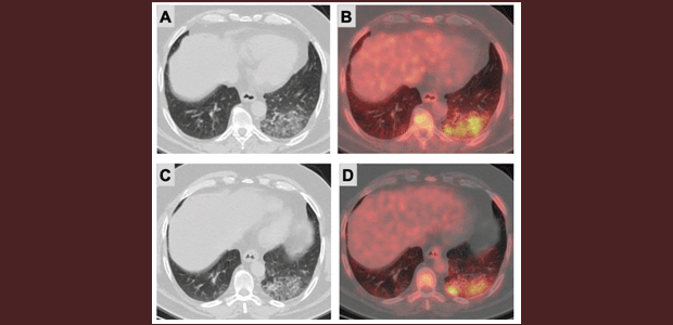 Immagine relativa al contenuto Imaging morfo-funzionale con PET/CT durante l'emergenza COVID-19
