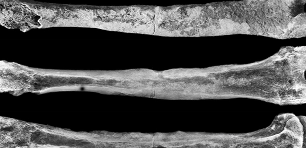 Immagine relativa al contenuto 5000 anni fa in Campania neurochirurgia per l'osteomielite post-traumatica