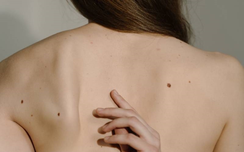 donna di spalle con nevi sulla schiena